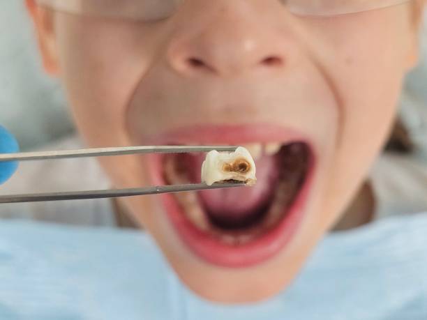 Best Emergency Wisdom Teeth Removal in Cedarville, OH